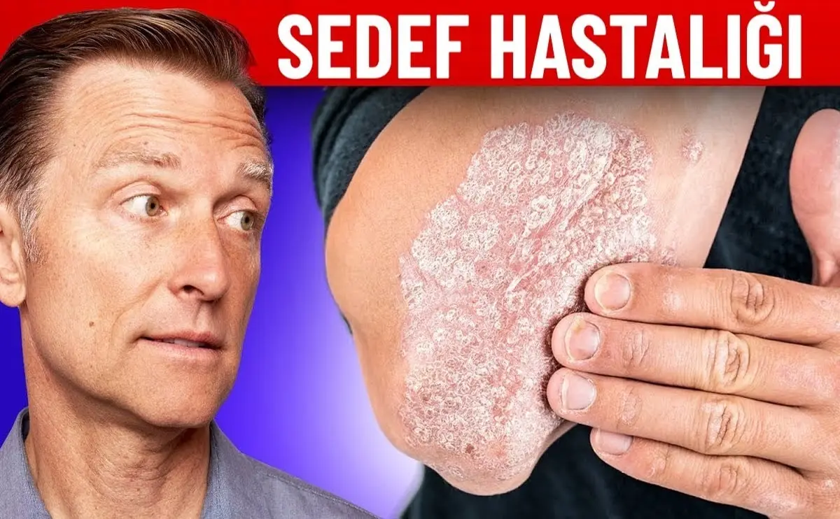 sedef hastalığı nedir